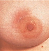 early stage of mastitis